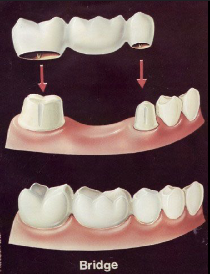 Best Dental Bridges in Abu Dhabi